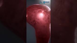 Robotics in Gynae Oncology: The Power of Precision