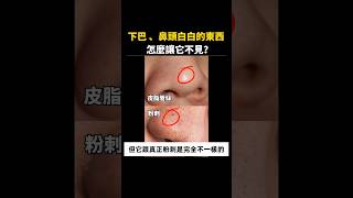 你以為的粉刺，其實不是粉刺 ▏皮膚科黃千耀醫師