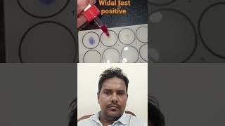 Widal Test Positive #widaltest #typhoid #widal #trending #trendingshorts #viral #viralvideo #shorts