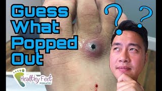 Guess What Popped Out of this Foot!  By Podiatrist Dr. Binh Nguyen