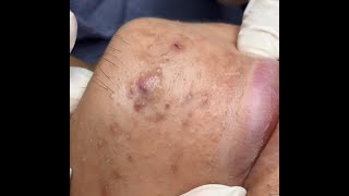 Blackhead removal,087, whitehead,pimple,acne,#blackheads , #acne ,#pimple ,#acnetreatment ,#asmr,#