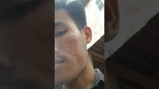 #115 #skincare #pimplelife #songlyrics #skincareroutine #pimplecare #music #duet #antipimple #song