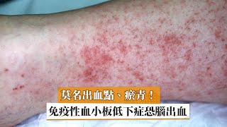 莫名出血點、瘀青！　免疫性血小板低下症恐腦出血