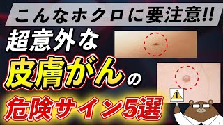 体にこんな「ほくろ」があったら絶対に見逃さないで！皮膚がんの危険な5つのサインとは？