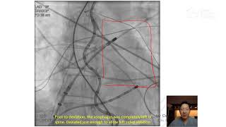 Expert Perspective with Felix Yang, MD, FHRS, CCDS: EsoSure Esophageal Deviator