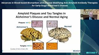 Blood Biomarkers and Disease-Modifying Anti-Amyloid Antibody Therapies for Early-Stage Alzheimer’s