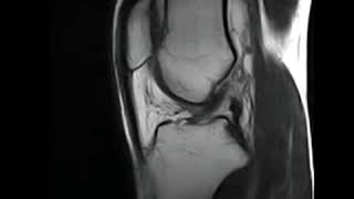 dynamic MRI of knee
