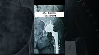 Hip replacement in TB hip with fracture  #shortsindia #hipreplacementsurgery