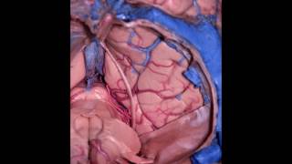 The paramedian supracerebellar-transtentorial approach to remove a posterior fusiform gyrus AVM