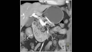 Adenocarcinoma Duodenum 3