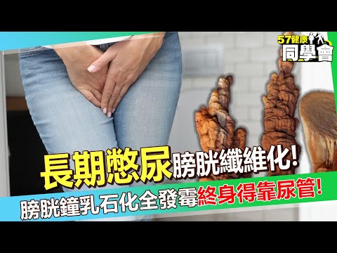 40歲女主管長期憋尿「尿不出來」才知膀胱纖維化！？ 膀胱鐘乳石化全發霉「終身得依靠導尿管」醫師嘆：沒救了！【 @57healthy  】#鄭丞傑 醫師