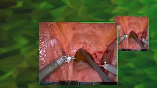 #242 Massive lymphorrhea after robot-assisted radical prostatectomy Dr. Riccardo Almeida