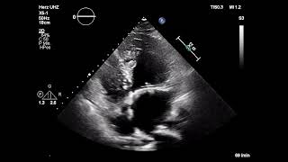 Asvide: Pretransplant four chamber view featuring the reconstructed tricuspid valve and the  …