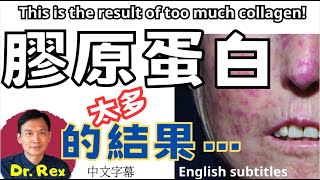 膠原蛋白是否越多越好？進來看看太多膠原蛋白的結果！Here is the horrible result of too much collagen