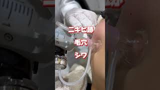 韓国からやってきた！最新美容機器！#美容#美肌#美容皮膚科 #ニキビ