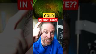 Golden Eye Floaters! (Asteroid Hyalosis)