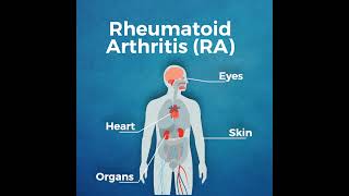 Chronic Conditions: Understanding Arthritis and its Symptoms | #shorts