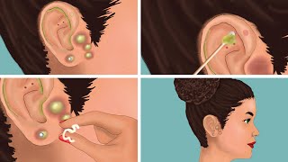 Digging Out Super Big Earwax | Ear Stone Removal | Asmr animations