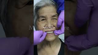 Milled full denture #cadcam #denture #dentalcare #geriatrics