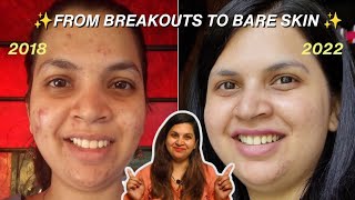 How I Healed My Cystic Acne Naturally (No Harsh Products!) | Skincare Journey & Tips ✨