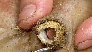 Sharp Ingrown Trimmed! Professional Pedicure DR LEE’S ULTIMATE ZITPOPPER 16062025ipv 2265