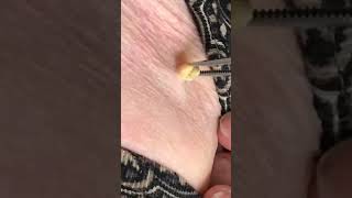 Who's had a big blackhead like this before and how did you get it removed?⁠⁠