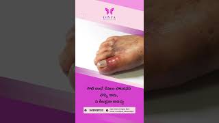 What is gout? Let's know here | Divya Rheumatology Centre | Narasaraopet