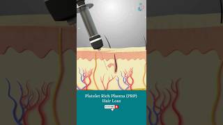 Platelet Rich Plasma and Its Use in Hair Regrowth ↪ 3D Medical Animation #Shorts #PRP #Hair #Health