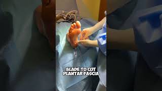 Plantar Fasciitis Surgery: A Step-by-Step Visual Guide #amazing