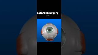 Cataract surgery {SICS} || #ophthalmology #eyes #ophthalmic #optometry #cataract
