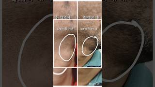 #alopecia #alopeciahairloss #homoeopathictreatment #shortsviral #shortsviral #shortvideo #homoeopath
