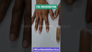 Silicone Cosmetic Finger I Revive Life Healthcare I +91 9643560798