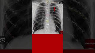 Identify posterior end of rib on chest x ray #shorts #xray #xraymachine #chestradiograph