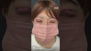 【勇気を出して目を切開した結果】#湘南美容クリニック#切開法 #ダウンタイム #二重整形 #二重整形経過#二重になりたい