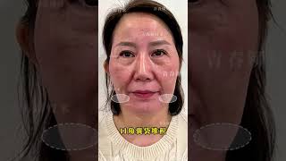 #变美小技巧 #抗衰 #面部年轻化 #面部提升