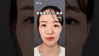 【糸リフト】美容整形した結果#shorts