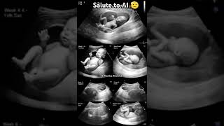 AI Videos on Ultrasound Scan in Pregnancy