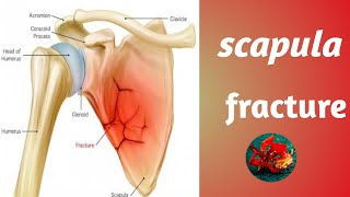 Scapula fracture