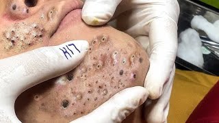 Pimple Popping Satisfying Video : Impressive Blackheads & Cyst Extractions #pimplepopping #acne #100