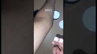 I Tried The Viral Pokonut Stretch Mark Remover