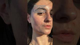 YOUR SKIN LOOKS LIKE THE MOON #acnepositivity #skinconfidence #skinjourney