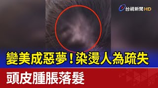 變美成惡夢！染燙人為疏失 頭皮腫脹落髮