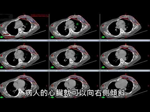 10-4乳癌右側斜躺治療左側治療