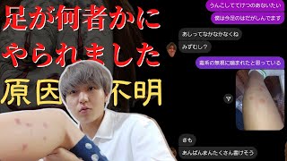 【悲劇】足に発疹が大量にできてしまった大学生。
