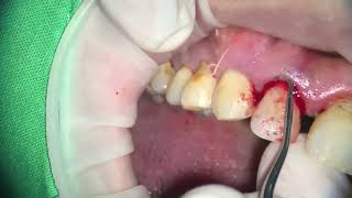 Tartar Bleeding gum with hand instruments｜光一顆牙就刮除超多結石