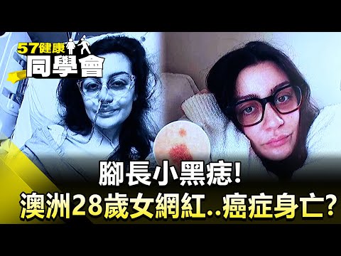 腳長小黑痣！澳洲28歲女網紅..癌症身亡？【@57healthy  】2024.11.16｜王暐婷、楊志賢、鄭雅勻、許瓊月、張翠芬