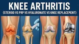 మోకాళ్ళ నొప్పి_వైద్యుని సలహాలు KNEE ARTHRITIS-TREATMENT #kneepain #doctor #osteoarthritis#bonehealth