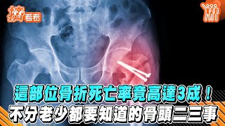 這部位骨折死亡率竟高達3成! 不分老少都要知道的骨頭二三事｜TVBS新聞｜擠看看