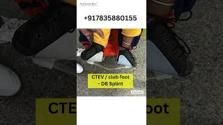 Clubfoot ka Ilaj| Bachpan Se Tedey Pair Ka Ilaj| CTEV (Clubfoot)| #clubfoot #orthotics #afo #shorts