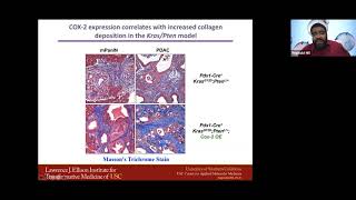 Cancer-Associated Fibroblast-Derived EVs Regulate Chemoresistance in Pancreatic Cancer by  R. Hill